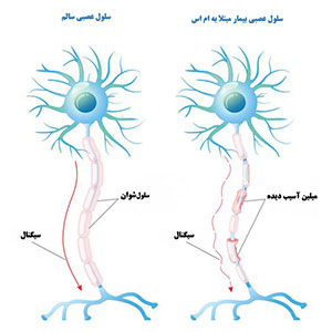 بیماری ام اس